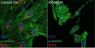 Heart muscle cells with mutations in the gene that makes the Rotatin protein (right) have disorganized muscle fibers (green) and immature cell division regulators (centrosomes in red) when compared to healthy heart muscle cells (left). Credit: Matthew Miyamoto.