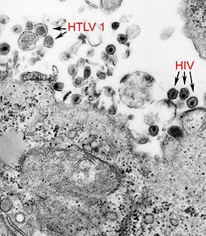 Dr. Gallo discovered two viruses - HTLV-1 and HIV