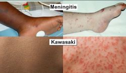 Meningitis and Kawasaki symptoms shown on light and dark skin