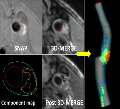 Plaque imaging