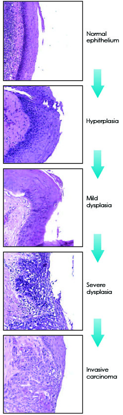 Head and neck cancer stages