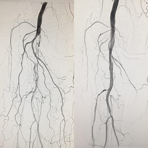 Angiograms before and after outpatient minimally-invasive treatment showing improved blood flow.