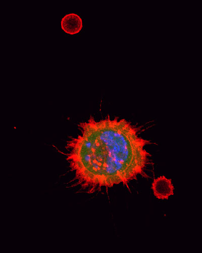 Microtentacles seen extending from a human breast tumor cell; cell was imaged on the TetherChip device after isolation from a blood sample.