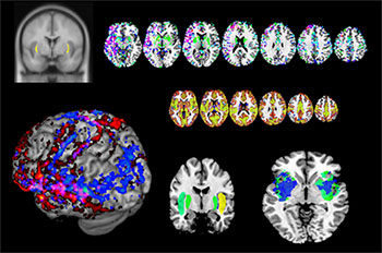Images of the brain’s claustrum activated when a person performs a complicated task