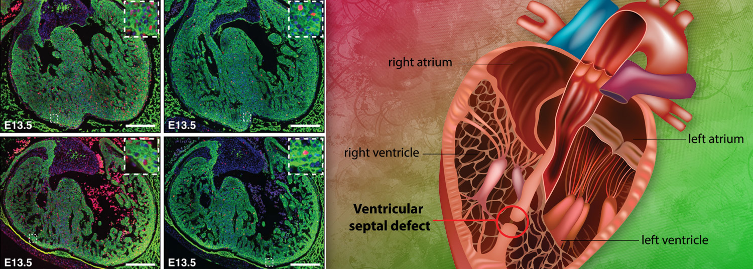 Learn about Congenital Heart Defects