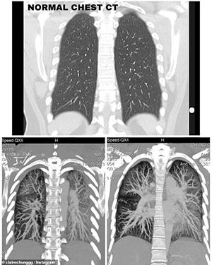 A CT scan of a healthy pair of lungs (Top) and a CT scan of a 19-year-old’s lungs affected by EVALI (Bottom), that shows extreme inflammation and significant loss of lung function.