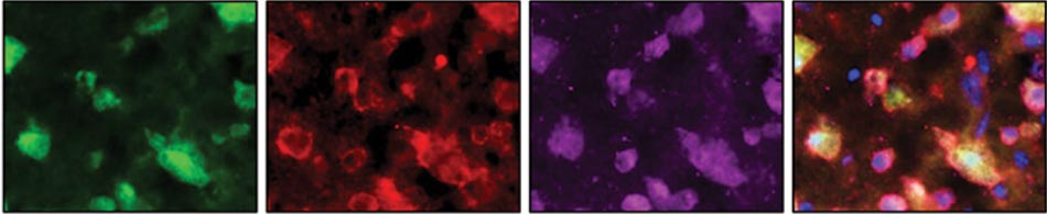 Markers of inflammation (red) and autophagy (purple) appear in brain cells 3 days after TBI