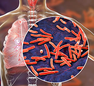 Tuberculosis
