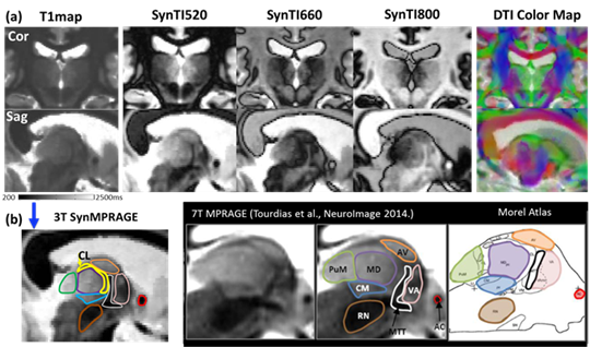 SynMPRAGE method for improved Thalamus sub-nuclei visualization