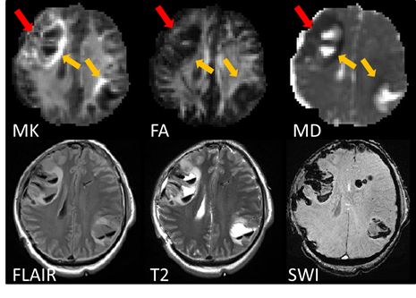 Advanced Neuroimaging in Traumatic Brain Injury